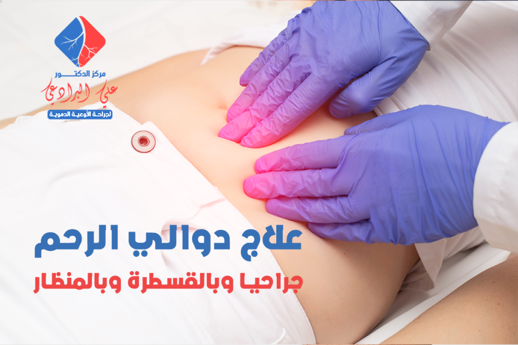 علاج دوالي الرحم