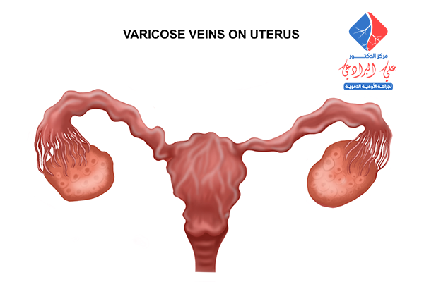 علاج دوالي الرحم