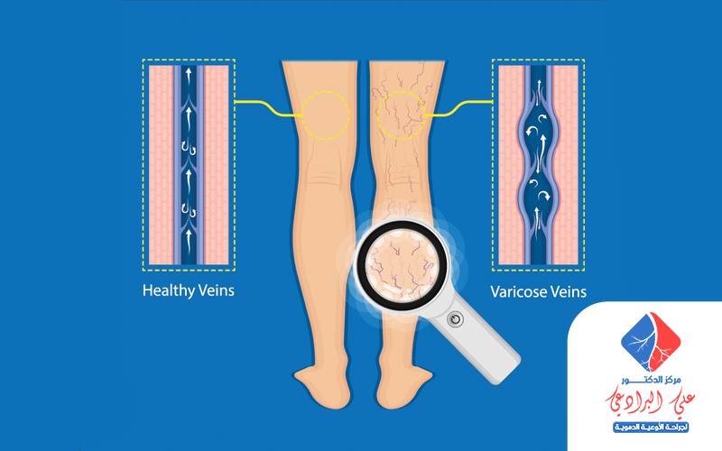 طرق علاج الدوالي الساقين