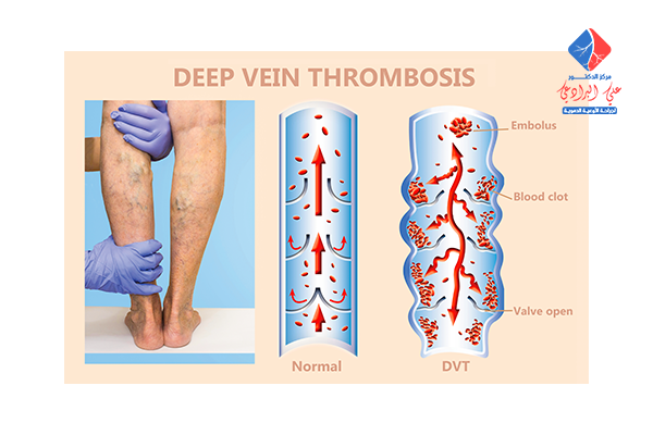 علاج جلطات الاوردة