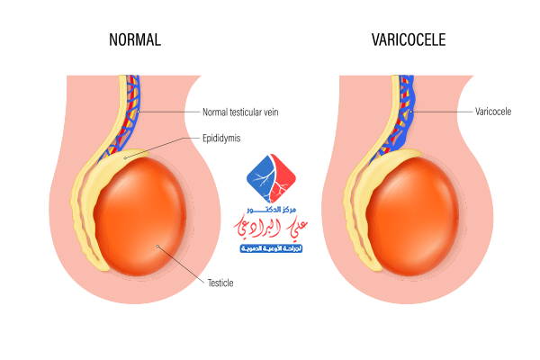 علاج الدوالي الخصية