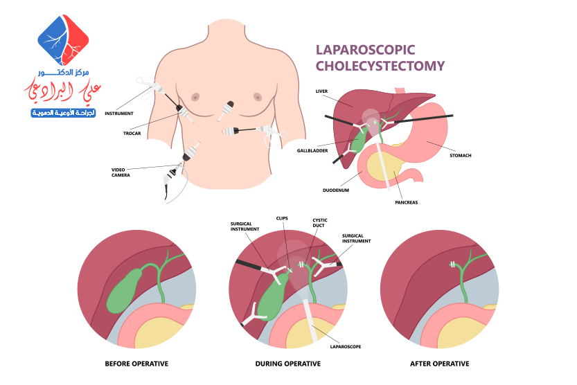 عملية استئصال المرارة