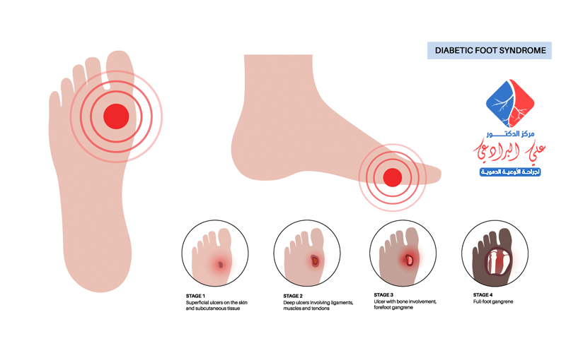 علاج القدم السكري