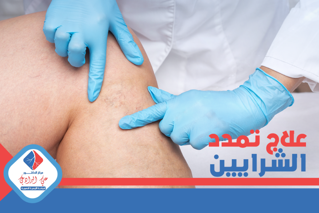 علاج تمدد الشرايين