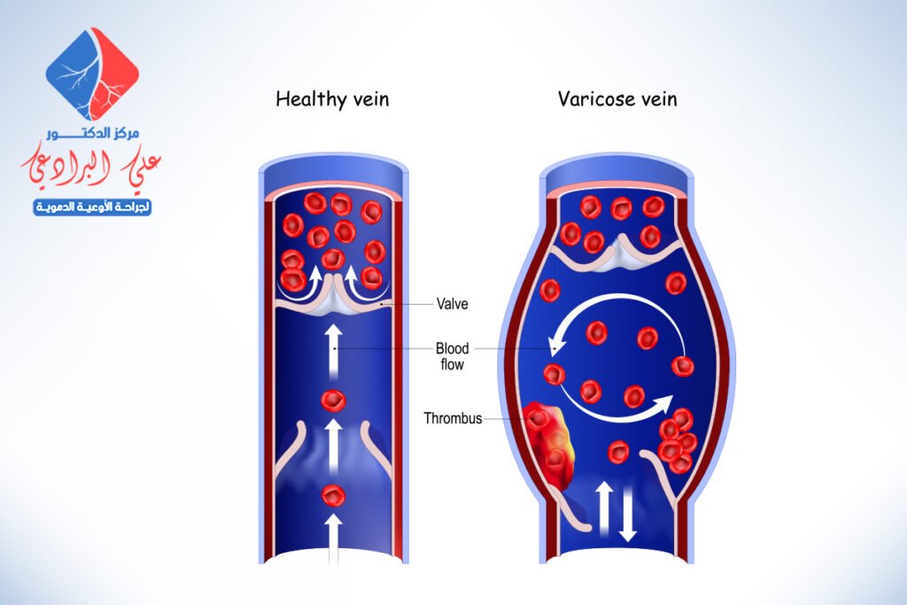 طرق علاج الدوالي الساقين
