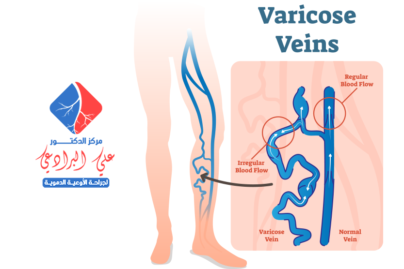 اسباب دوالي الساقين عند النساء