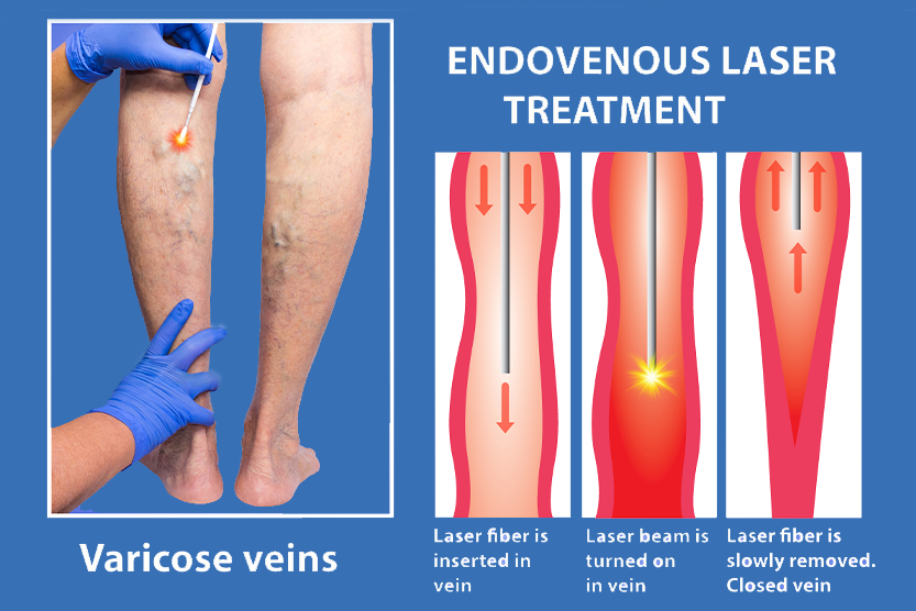 علاج دوالي الساقين بالليزر