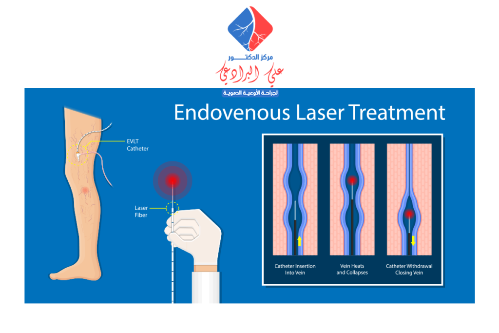 دكتور علاج الدوالي بالليزر