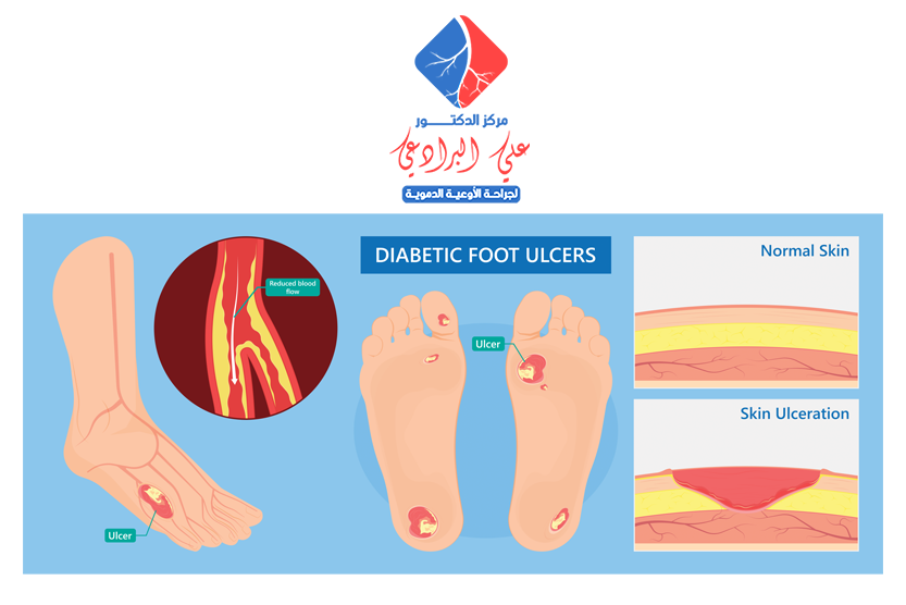 دكتور علاج القدم السكري