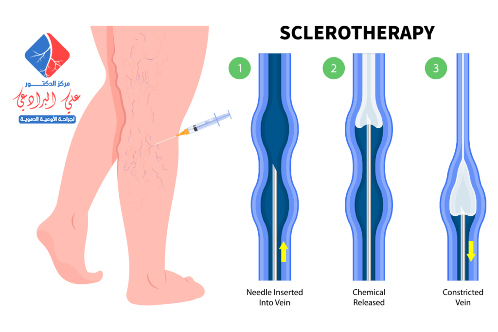 دكتور علاج الدوالي بالليزر