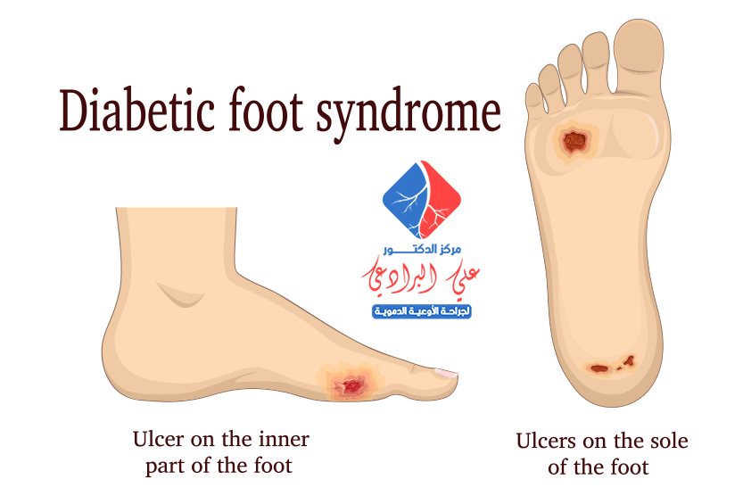 احمرار القدمين عند مريض السكر
