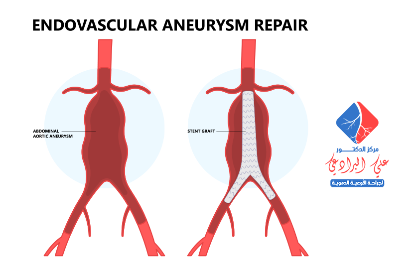 علاج تمدد الشريان الأورطي البطني