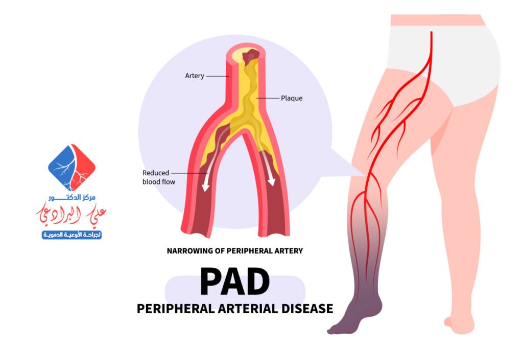 علاج انسداد الشرايين في الرجل