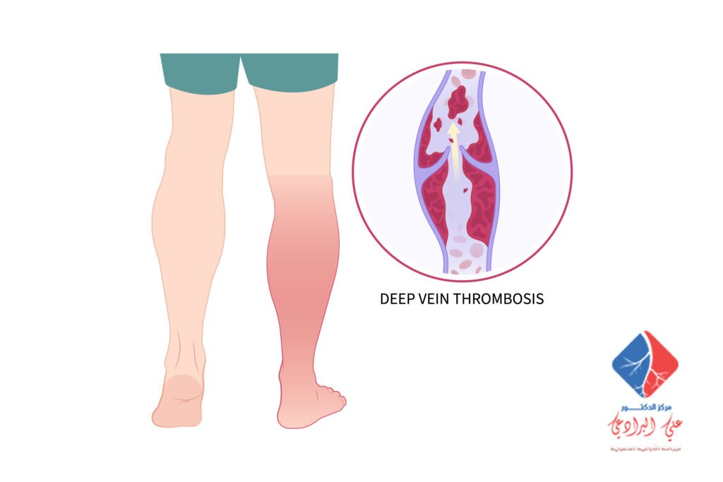 علاج الجلطات الدموية في الساق