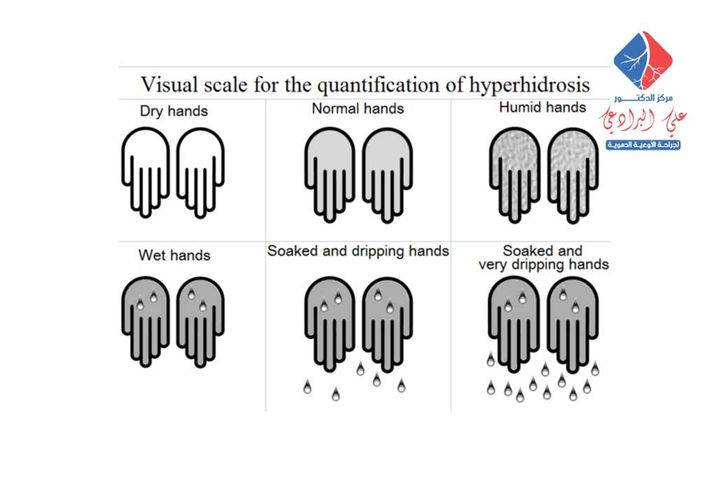 علاج تعرق اليدين والقدمين