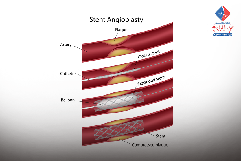 كيفية علاج انسداد الشرايين