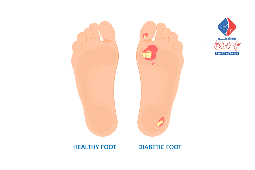 علاج جروح القدم لمرضى السكري