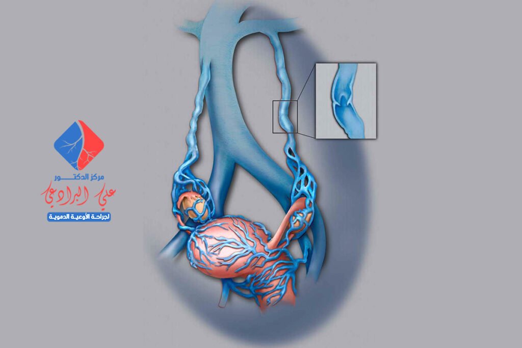 اسباب دوالي الرحم