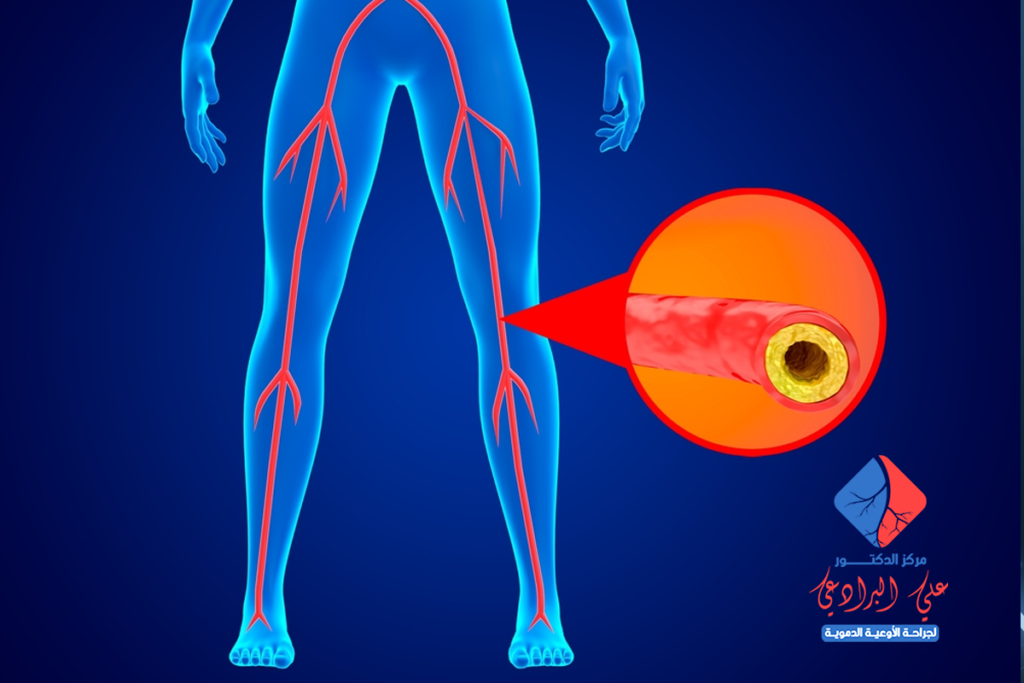 اعراض انسداد الشرايين وعلاجها