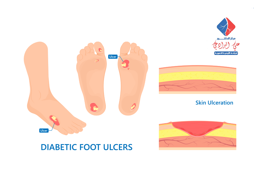 علاج جروح القدم لمرضى السكري