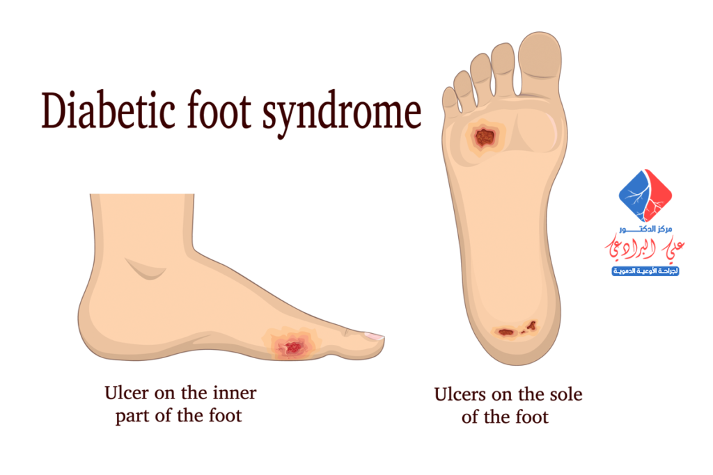 علاج حرقان القدم لمرضى السكر