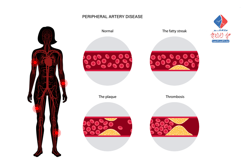 علاج ضيق الاوعية الدموية الطرفية
