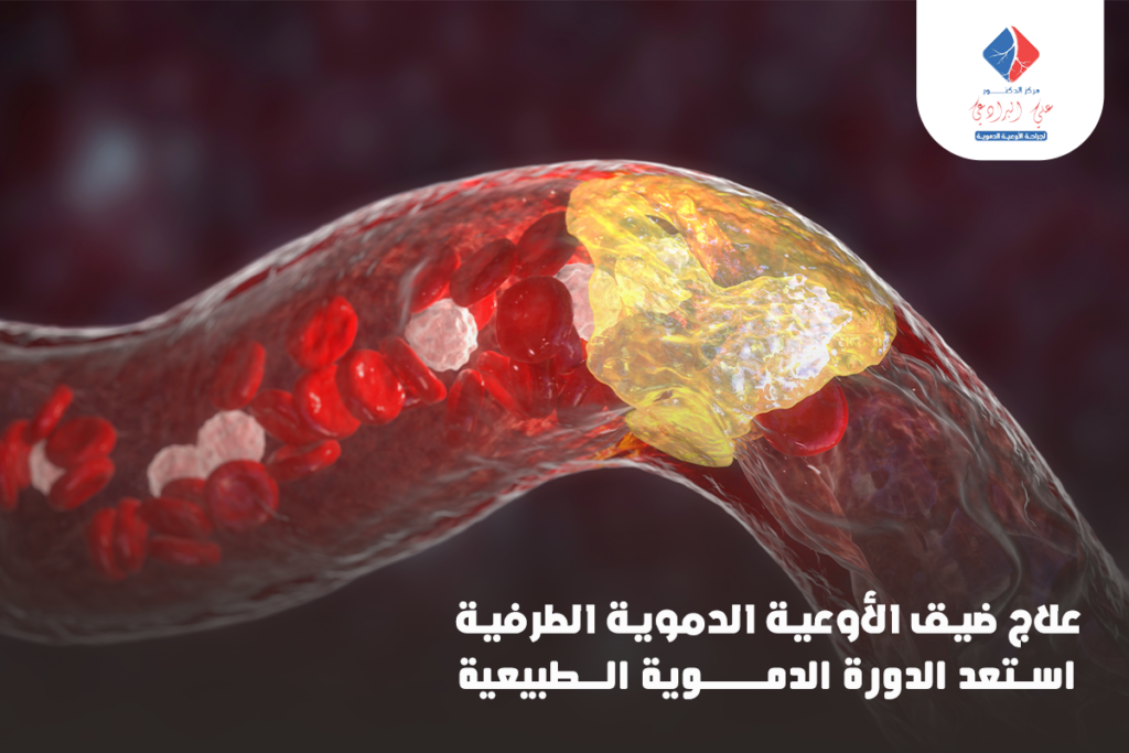 علاج ضيق الاوعية الدموية الطرفية