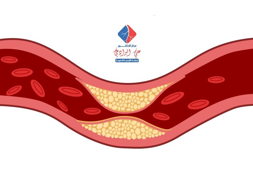 الوقاية من انسداد الشرايين