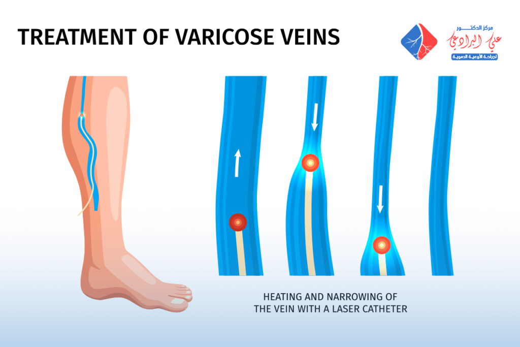تكلفة عملية دوالي الساقين بالليزر