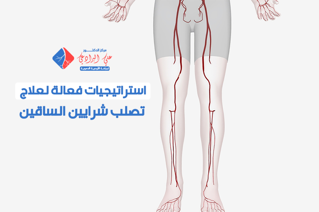 علاج تصلب شرايين الساقين​