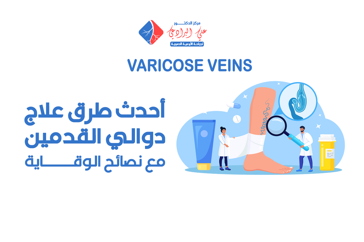 طرق علاج دوالي القدمين