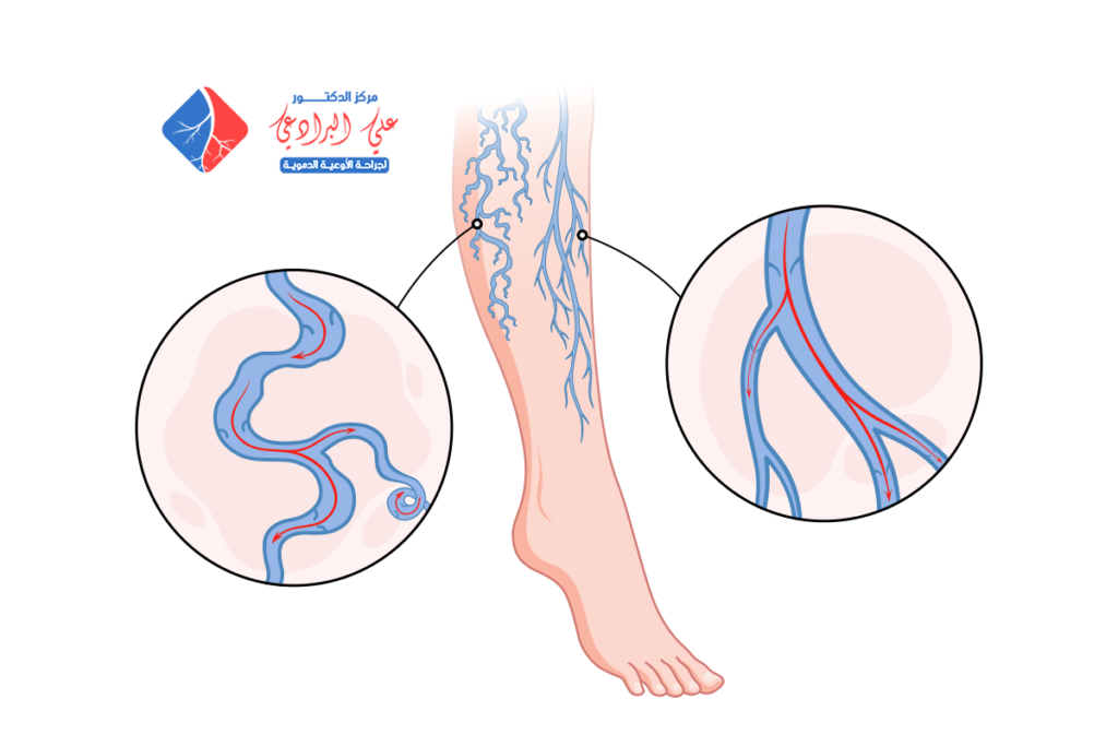 مركز علاج دوالي الساقين