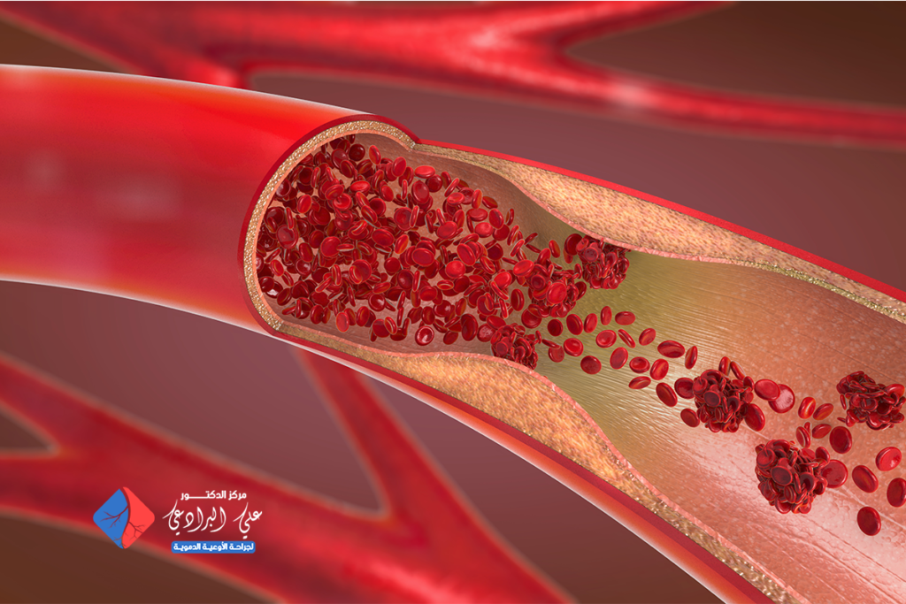 علاج تصلب شرايين الساقين​