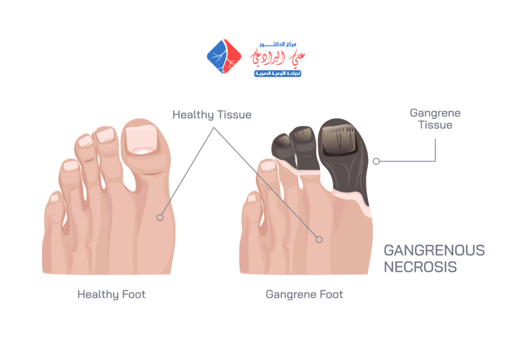 اعراض الغرغرينا في اصابع القدمين