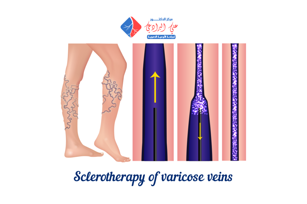 مركز لعلاج الدوالي بالليزر