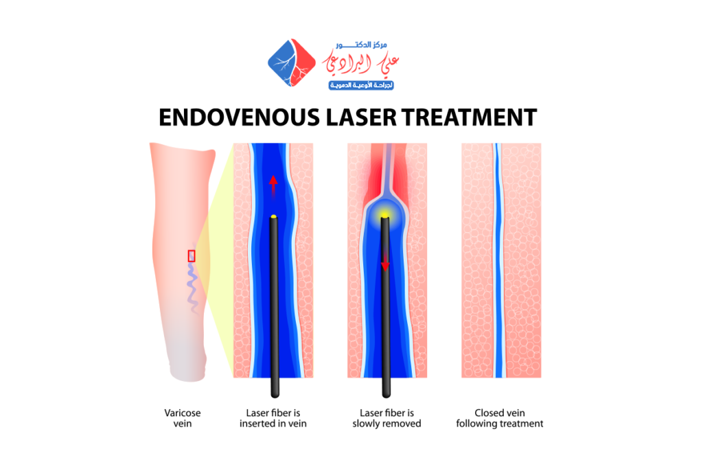 مركز لعلاج الدوالي بالليزر