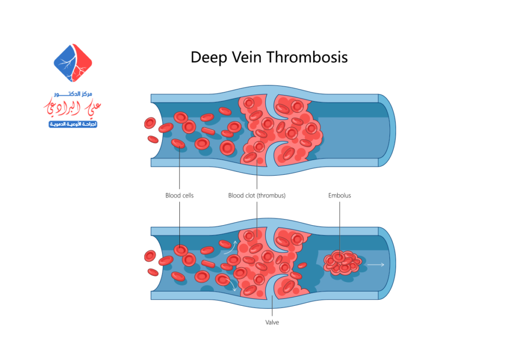 اعراض جلطة الاوردة العميقة