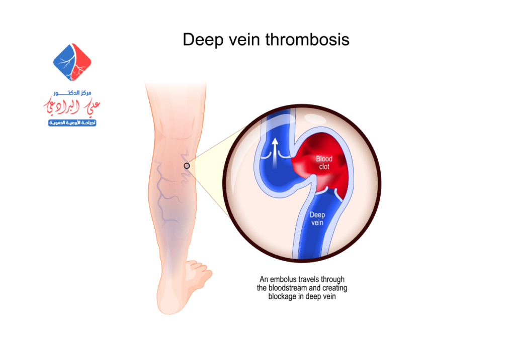 اعراض جلطة الاوردة العميقة