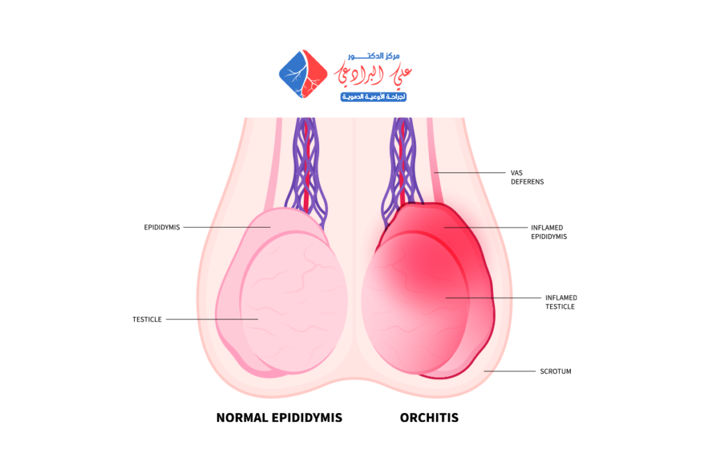 عملية دوالي الخصية بالمنظار