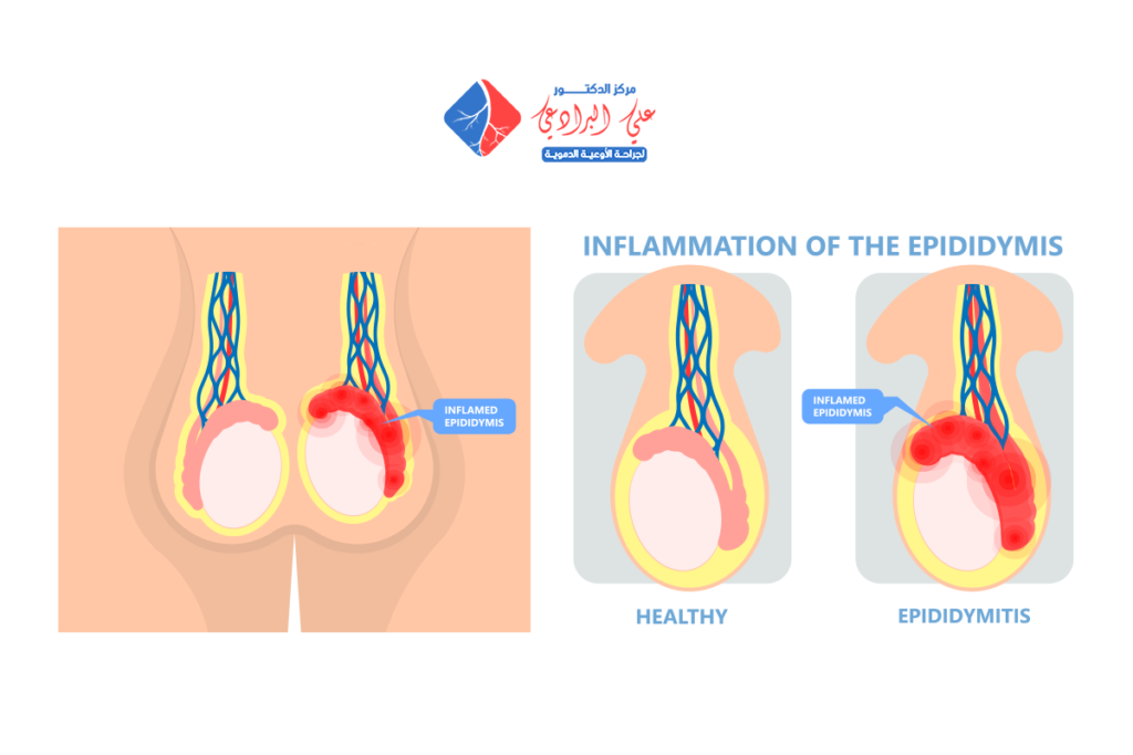 عملية دوالي الخصية بالمنظار