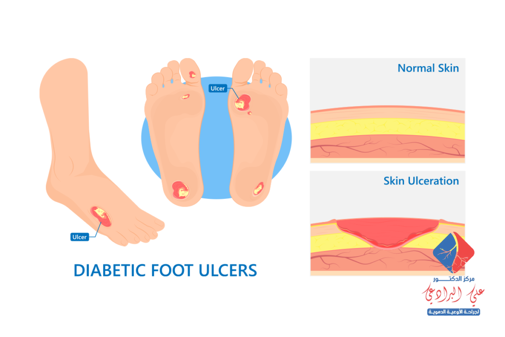اعراض القدم السكري وعلاجه​