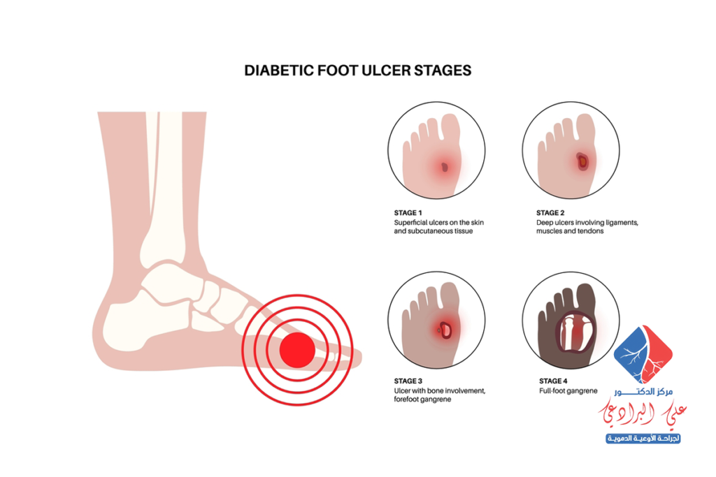 اعراض القدم السكري وعلاجه​