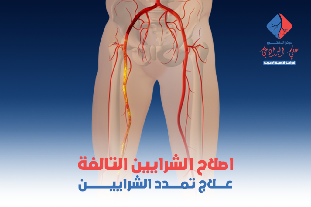 علاج تمدد الشرايين​