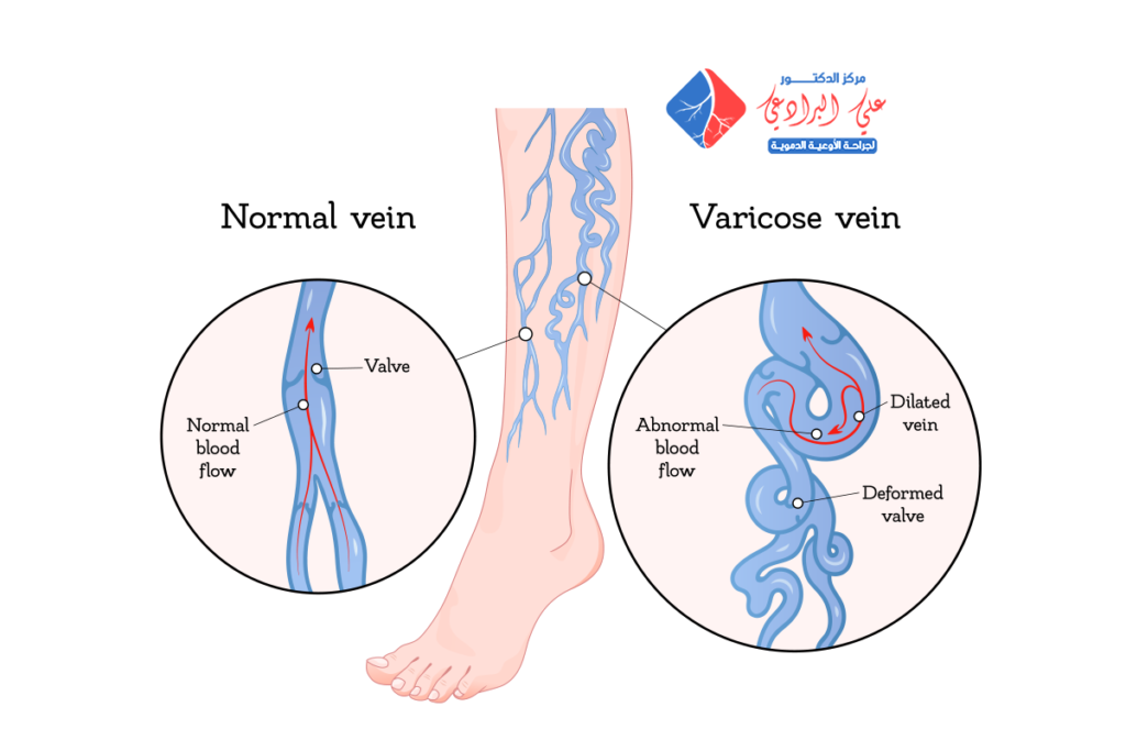 علاج الاوعيه الدمويه في الرجل​