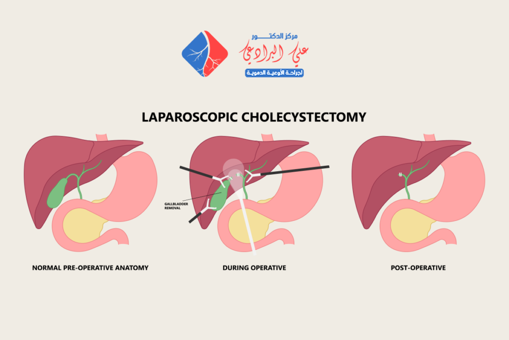 نصائح بعد استئصال المرارة بالمنظار​