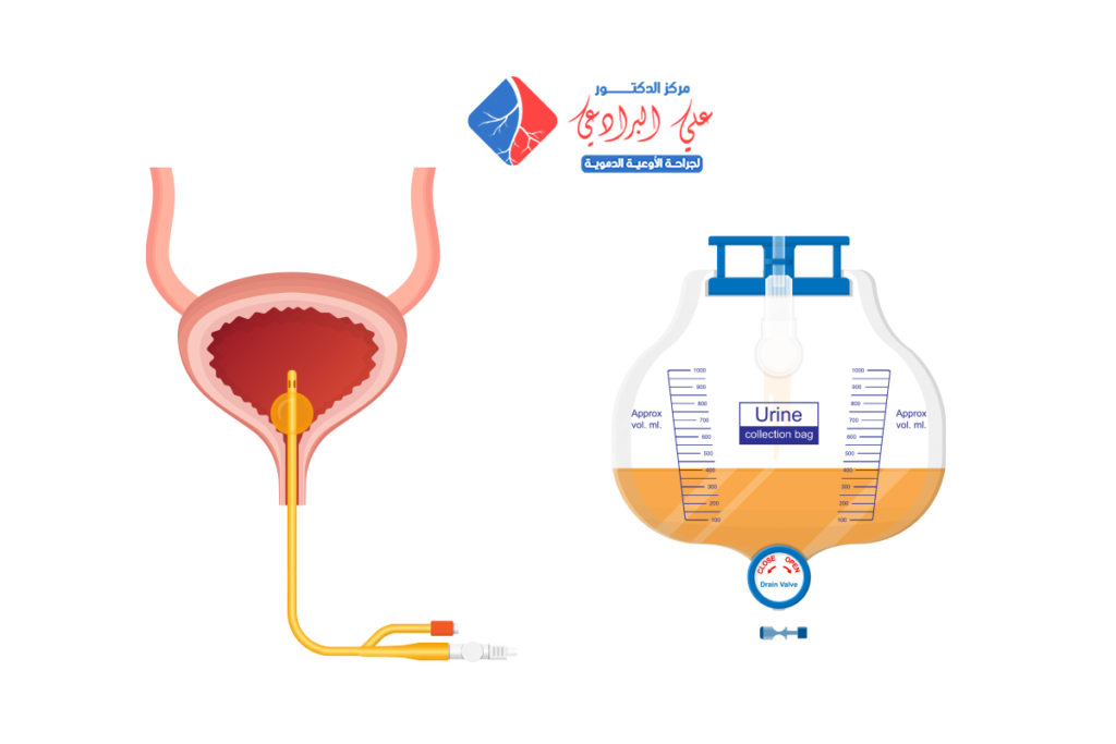 ما هي القسطرة العلاجية​