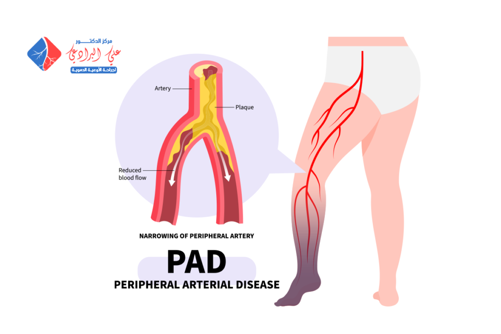 امراض الاوعية الدموية في القدم​