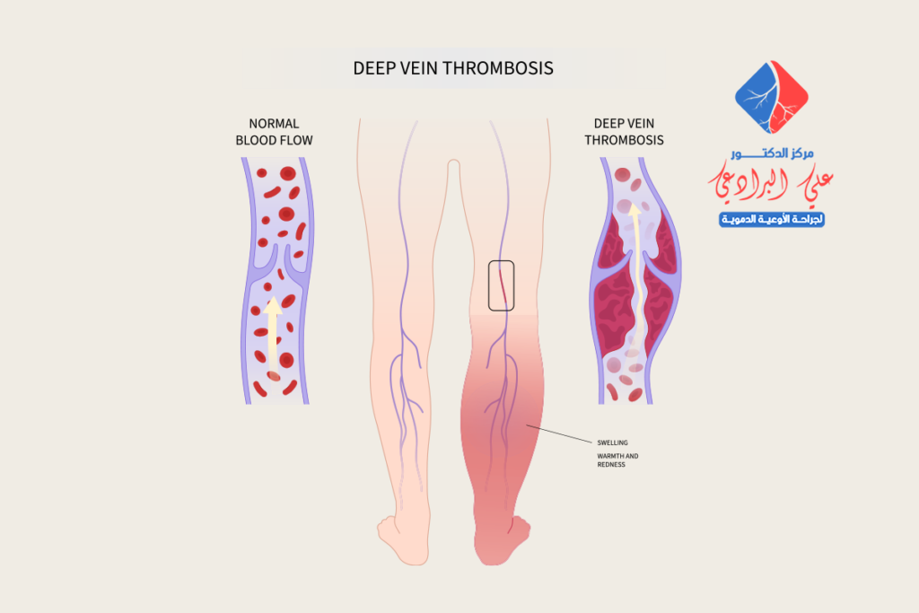 الجلطة الوريدية في الساق​