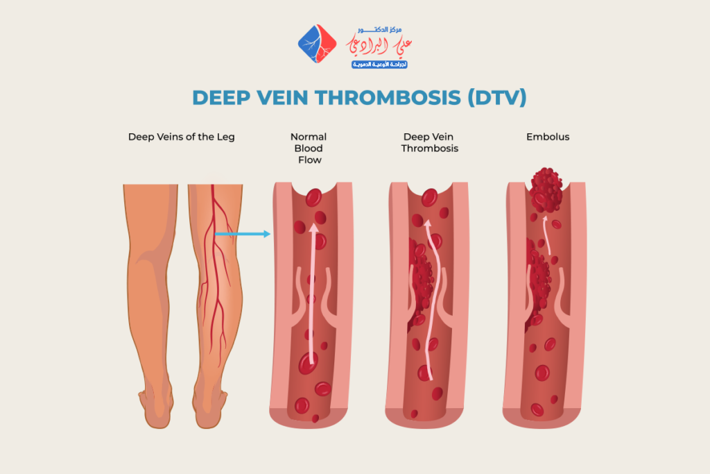 الجلطة الوريدية في الساق​