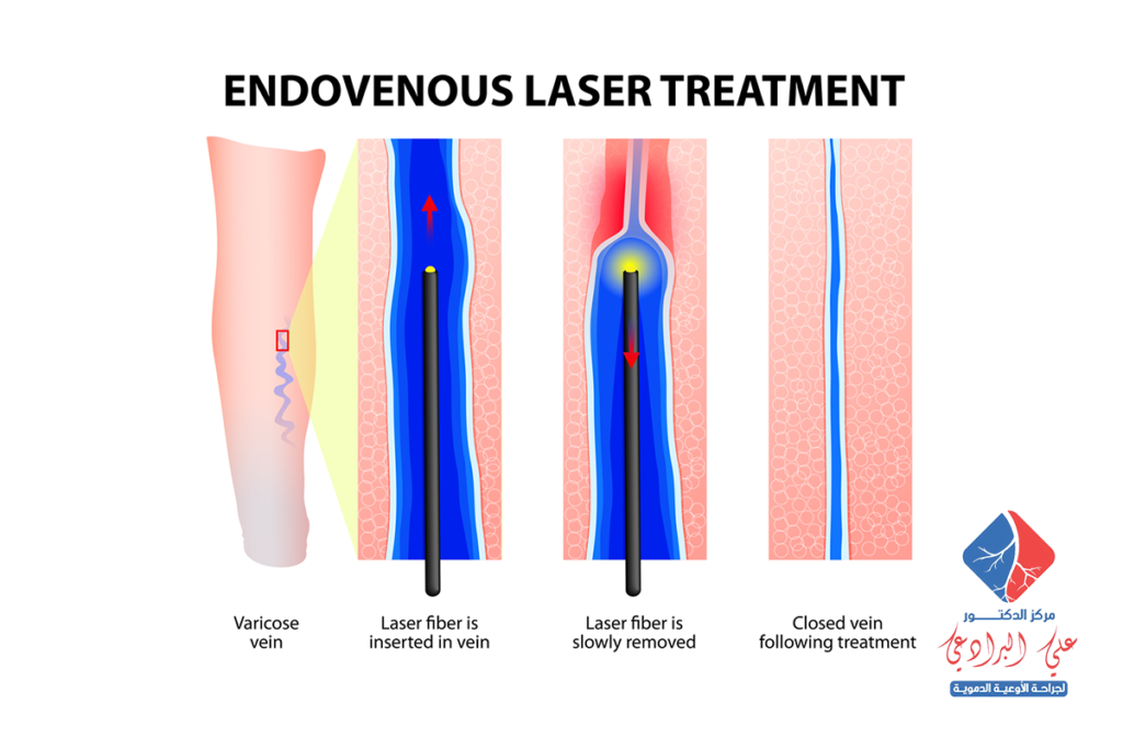 علاج الدوالي بالليزر​